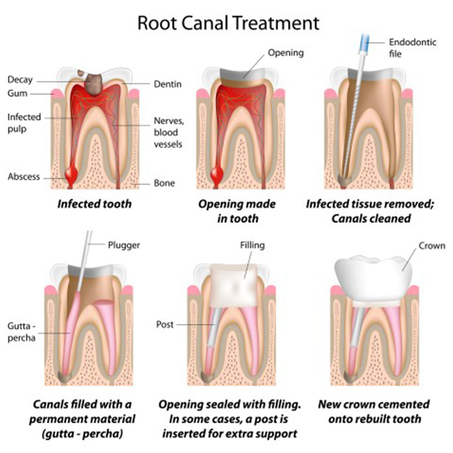 root canal therapy Dallas