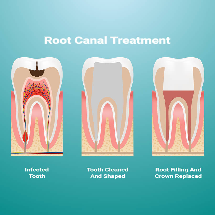 root canal treatment infographic