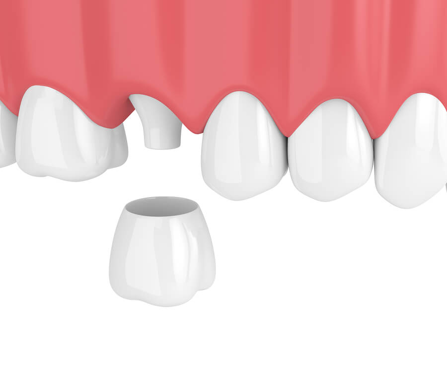 dental crown infographic