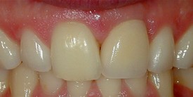 teeth after dental implant
