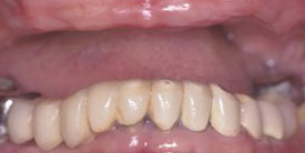 teeth before dental implants
