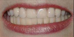 teeth after dental implants