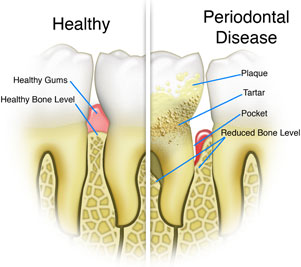 healthy gums vs periodontal disease infographic