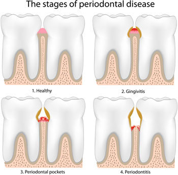 stages of periodontal disease infographic