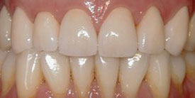 teeth after porcelain crown