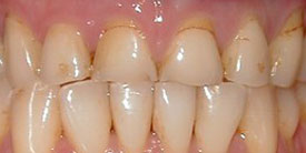 teeth before porcelain crown