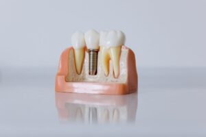 Photo by cottonbro studio: https://www.pexels.com/photo/close-up-shot-of-dental-implant-model-6502305/ close up of dental implant model teeth